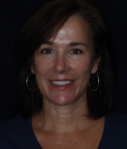 Buckhead Dental Crowns with Dr. Todd Davis